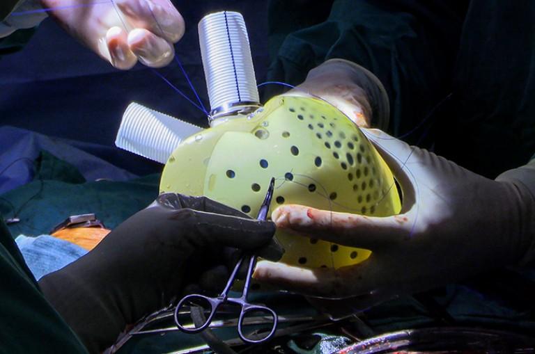 Heart Transplant